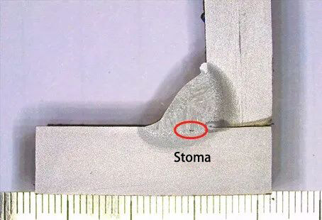 Stoma